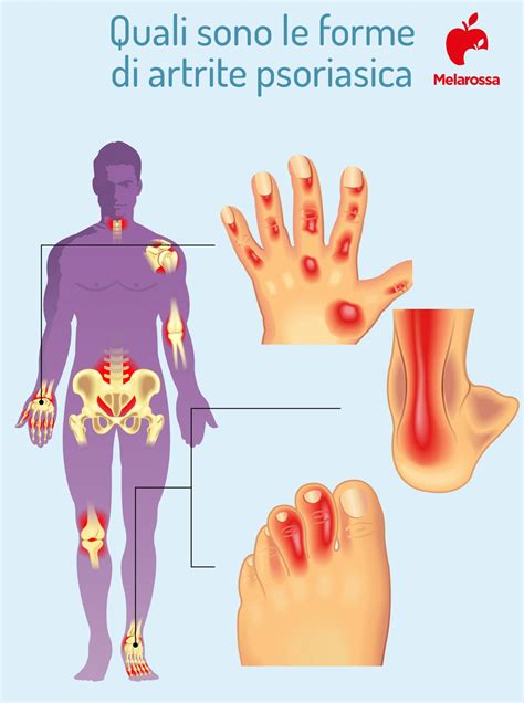 Diagramma che illustra le connessioni tra psoriasi, artrite psoriasica e malattie cardiovascolari