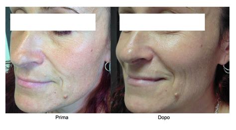 Cicatrici del viso prima e dopo trattamento