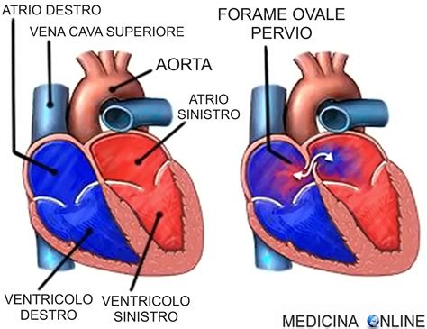Illustrazione dell'embolia paradossa attraverso un forame ovale pervio