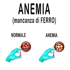 Tabella comparativa dei parametri ematici nell'anemia da carenza di ferro e nell'anemia da malattia cronica