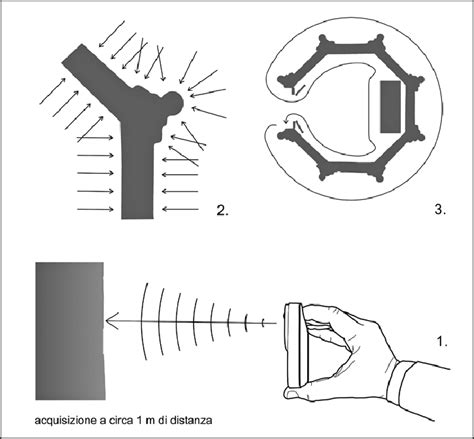 Schema che illustra la posizione dell'incisione periareolare