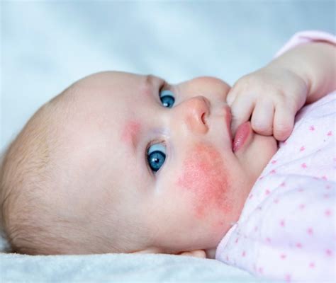 Bambino con dermatite atopica, mostrando la tipica eruzione cutanea sulle guance