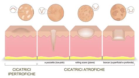 Illustrazione dei diversi tipi di cicatrici da acne: atrofiche (ice pick, boxcar, rolling), ipertrofiche e cheloidi.