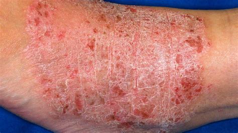 Pelle con eczema lichenificato