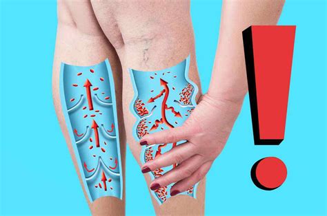 Gambe gonfie e pesanti