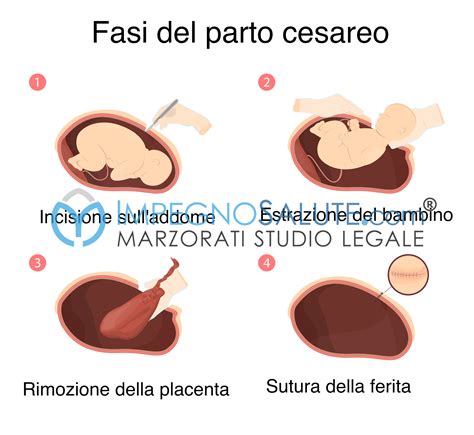 Schema delle aderenze interne dopo taglio cesareo