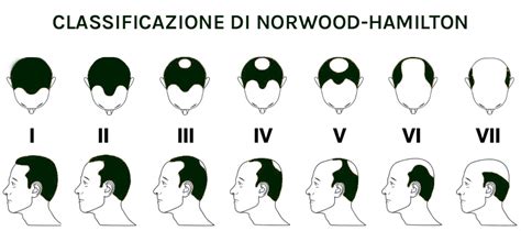 Illustrazione che mostra i diversi stadi della calvizie maschile secondo la Scala di Norwood.