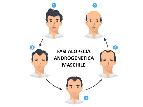 Illustrazione che confronta la tipica manifestazione dell'alopecia androgenetica maschile e femminile.