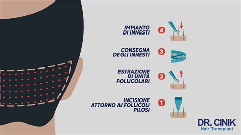 Immagine che mostra il processo di estrazione e reimpianto delle unità follicolari durante un trapianto di capelli FUE.