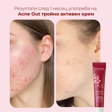 Immagine comparativa di pelle con acne trattata con retinolo e pelle non trattata