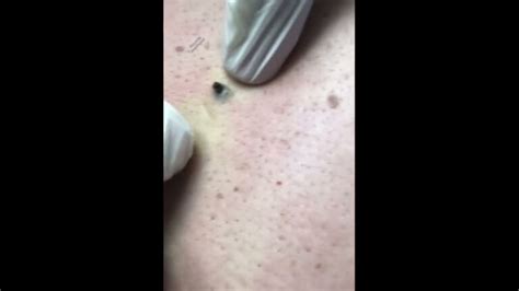 Diagramma che mostra la formazione di un punto nero (comedone aperto)