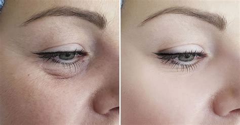 Pelle sottile del contorno occhi