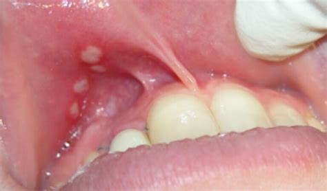 Diagramma diagnostico differenziale delle ulcere orali