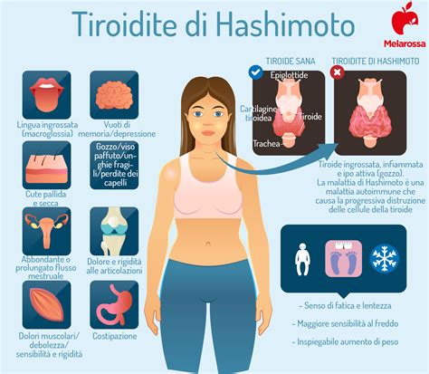 Grafico a barre che compara il rischio di tiroidite di Hashimoto in pazienti con psoriasi rispetto ai controlli