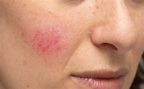 Pelle sensibile e prodotti dermocosmetici