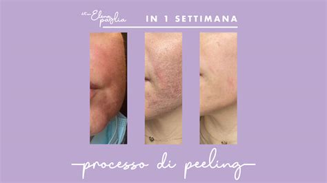 Schema di funzionamento del peeling chimico