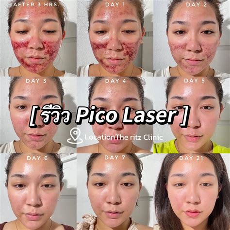 schema confronto laser CO2 e laser Pico