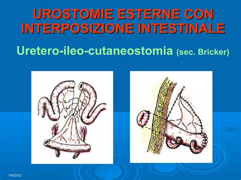 Schema di una uretero-ileo-cutaneostomia