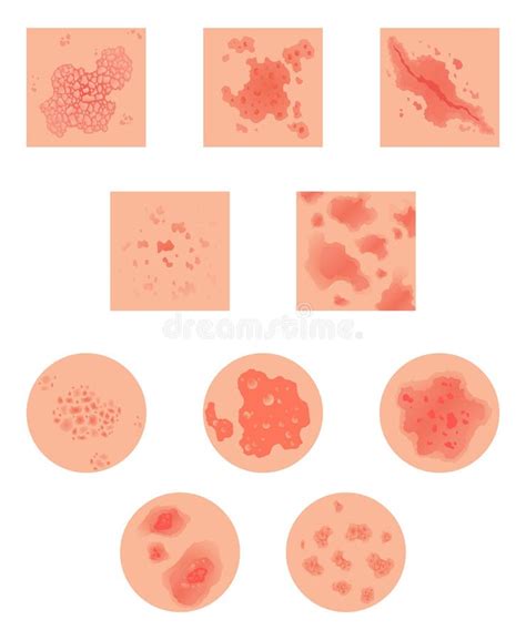 Illustrazione di diversi tipi di rash cutanei