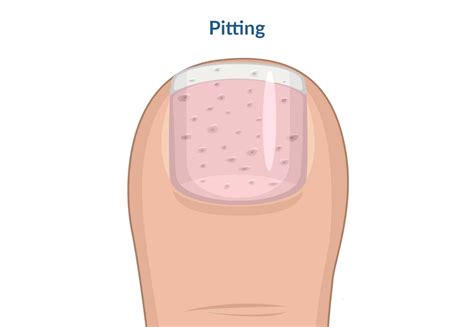 Immagine di unghie con pitting ungueale (aspetto a ditale)