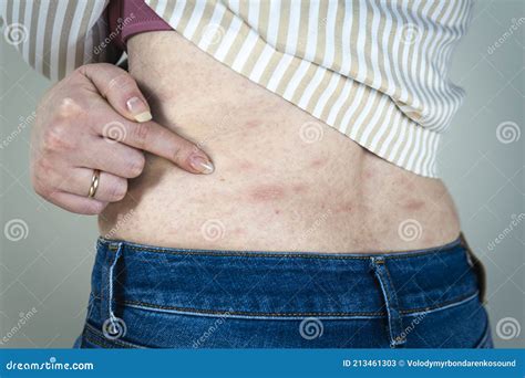 Illustrazione di una eruzione cutanea pruriginosa