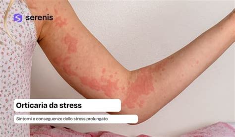 Illustrazione di orticaria con pomfi e prurito