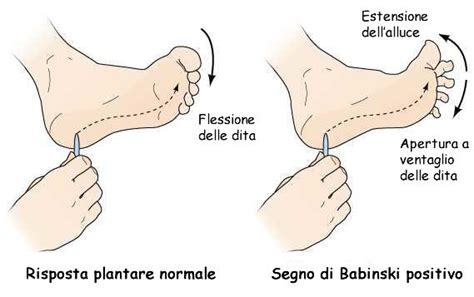 Illustrazione del segno di Babinski: piede con alluce esteso e dita a ventaglio