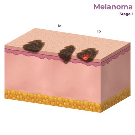 Illustrazione che mostra la progressione del melanoma dalla pelle ai linfonodi e agli organi distanti.