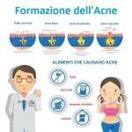 Diagramma che illustra i quattro fattori principali che causano l'acne: sebo in eccesso, ipercheratinizzazione, batteri e infiammazione.