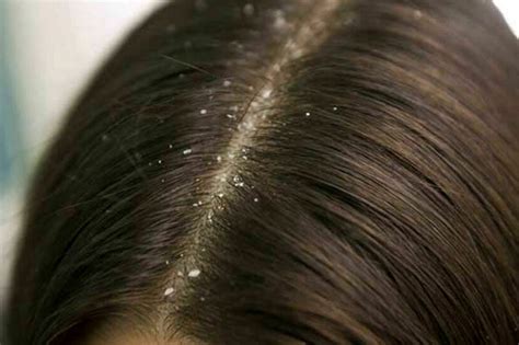 Cuoio capelluto con chiazze rosse e desquamazione