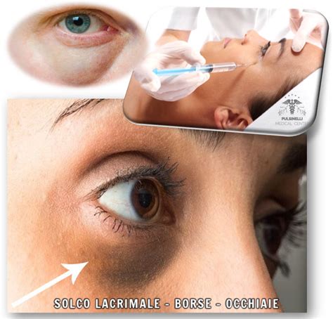 Diagramma che illustra l'iniezione di filler sotto l'occhio per correggere il solco lacrimale