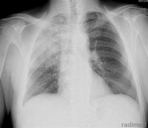 Immagine di una radiografia polmonare che evidenzia un addensamento