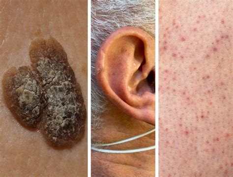 Illustrazione di diverse cheratosi attiniche su viso e mani