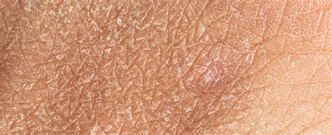 Immagine che mostra una pelle con croste sottili e desquamazione dopo un trattamento laser