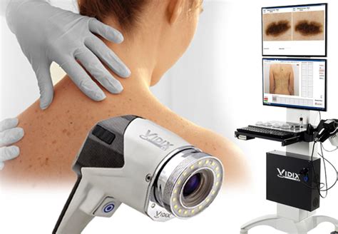 Videodermatoscopia digitale