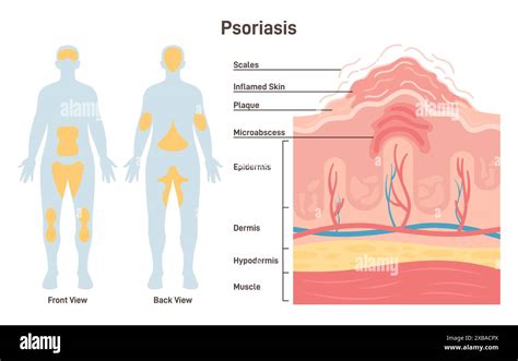 Illustrazione scientifica della psoriasi mostrando le placche e la rapida proliferazione cellulare