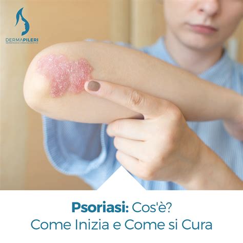 Infografica che illustra l'impatto psicologico della psoriasi