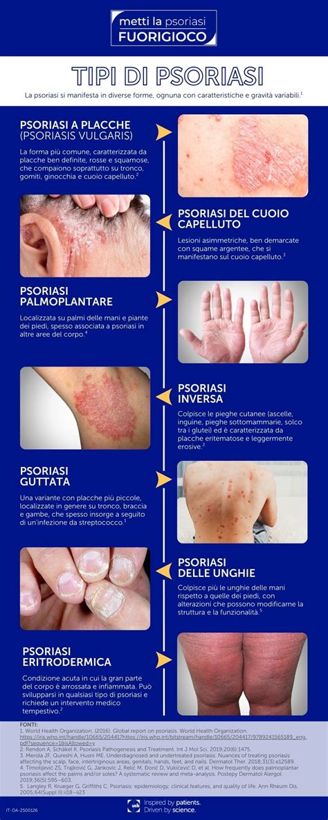 Schema che illustra i diversi tipi di psoriasi
