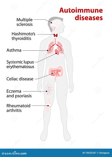 Schema che illustra l'attacco autoimmune ai melanociti