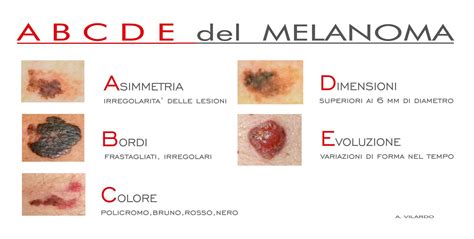 Schema riassuntivo dei criteri ABCDE per il riconoscimento del melanoma