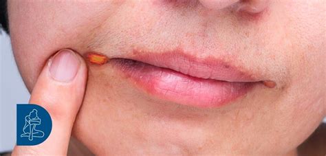 Diagramma delle cause della cheilite angolare