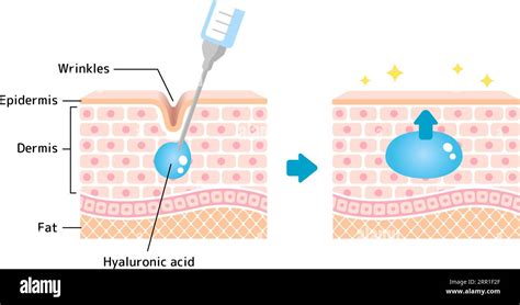 Diagram showing the action of hyaluronic acid on the skin