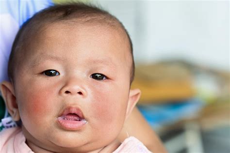bambino con eczema sul viso