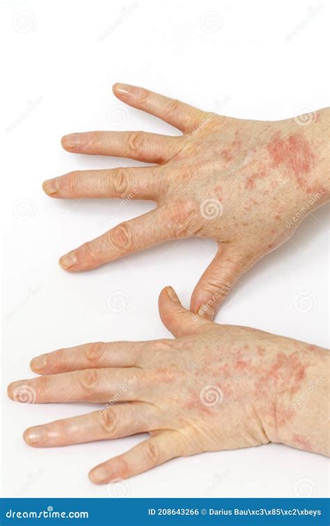 mani con dermatite allergica da contatto