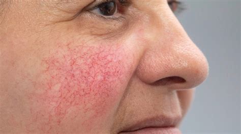 Immagine di una pelle con rossori e piccole pustole tipiche della rosacea