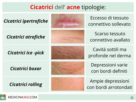 Tipologie di cicatrici da acne