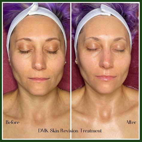 Concetto di Skin Revision DMK