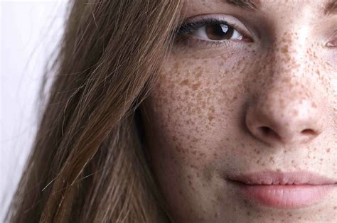 Persona con lentiggini sul viso