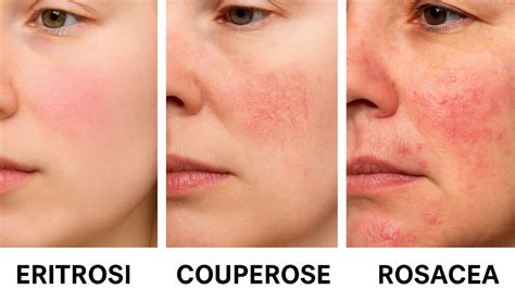 Schema di una routine di skincare per la pelle con rosacea