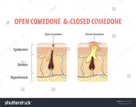 Diagramma comparativo tra comedone aperto e chiuso
